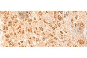 Immunohistochemistry of paraffin-embedded Human esophagus cancer tissue using DBP Polyclonal Antibody at dilution of 1:25(x200)