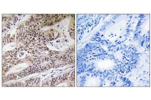 Immunohistochemistry analysis of paraffin-embedded human colon carcinoma tissue using NPHP4 antibody. (NPHP4 anticorps  (Internal Region))