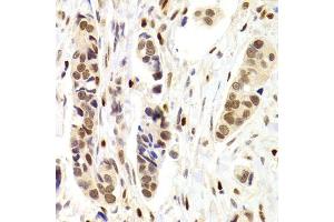 Immunohistochemistry of paraffin-embedded human breast cancer using NASP Antibody. (NASP anticorps)