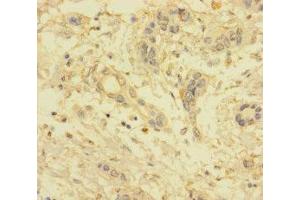 Immunohistochemistry of paraffin-embedded human pancreatic cancer using ABIN7175533 at dilution of 1:100