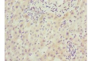 Immunohistochemistry of paraffin-embedded human liver cancer using ABIN7168604 at dilution of 1:100