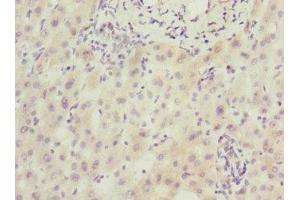 Immunohistochemistry of paraffin-embedded human liver cancer using ABIN7168604 at dilution of 1:100 (SCAND1 anticorps  (AA 1-179))