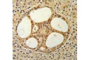 Immunohistochemistry analysis in prostate carcinoma (Formalin-fixed, Paraffin-embedded) using PRUNE  Antibody (C-term), followed by peroxidase conjugation of the secondary antibody and DAB staining. (PRUNE anticorps  (C-Term))