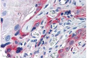 Human Placenta (formalin-fixed, paraffin-embedded) stained with TGM2 antibody ABIN337398 at 5 ug/ml followed by biotinylated goat anti-rabbit IgG secondary antibody ABIN481713, alkaline phosphatase-streptavidin and chromogen. (Transglutaminase 2 anticorps)