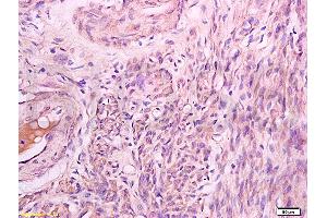 Formalin-fixed and paraffin embedded human lung carcinoma labeled with Rabbit Anti Phospho-Talin (Ser425) Polyclonal Antibody, Unconjugated (ABIN703135) at 1:200 followed by conjugation to the secondary antibody and DAB staining