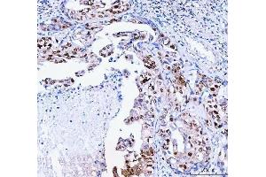 IHC analysis of FEN1 using anti-FEN1 antibody (ABIN7601617). (FEN1 anticorps  (AA 4-300))