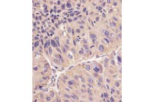 B staining hFACL4 in human human hepatocarcinoma sections by Immunohistochemistry (IHC-P - paraformaldehyde-fixed, paraffin-embedded sections).