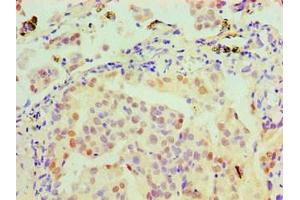 Immunohistochemical of paraffin-embedded Human lung cancer tissue using ABIN7160272 at dilution of 1:200. (MSH6 anticorps)