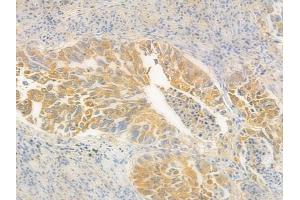 ABIN6265850 and ABIN6278111 at 1/100 staining human lung squamous cell carcinoma by IHC-P. (UBE2L3 anticorps  (C-Term))