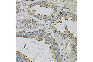 Immunohistochemistry of paraffin-embedded human prostate using ALDH3A1 Antibody (ABIN6290003) at dilution of 1:100 (40x lens). (ALDH3A1 anticorps)