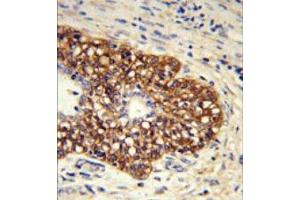 Formalin-fixed and paraffin-embedded human prostate carcinoma reacted withPTGIS Antibody (C-term) followed which was peroxidase-conjugated to the secondary antibody, followed by DAB staining.