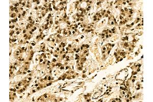 Phospho-Jak2 (Tyr1008) Antibody at 1/100 staining Human liver cancer by IHC-P.