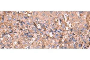 Immunohistochemistry of paraffin-embedded Human liver cancer tissue using NOTCH4 Polyclonal Antibody at dilution of 1:30(x200)