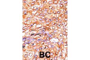 Formalin-fixed and paraffin-embedded human breast cancer tissue reacted with DUSP10 polyclonal antibody  , which was peroxidase-conjugated to the secondary antibody, followed by AEC staining. (DUSP10 anticorps  (N-Term))
