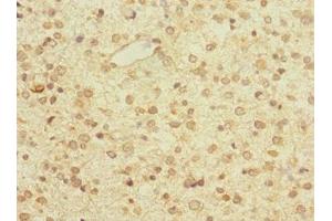 Immunohistochemistry of paraffin-embedded human glioma using ABIN7176525 at dilution of 1:100 (ZNF774 anticorps  (AA 101-300))