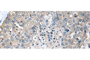 Immunohistochemistry of paraffin-embedded Human liver cancer tissue using TGM3 Polyclonal Antibody at dilution of 1:55(x200)