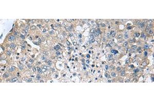 Immunohistochemistry of paraffin-embedded Human liver cancer tissue using TGM3 Polyclonal Antibody at dilution of 1:55(x200) (TGM3 anticorps)