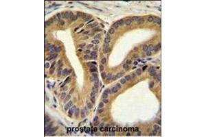 TRIM65 Antibody (Center) (ABIN655759 and ABIN2845202) immunohistochemistry analysis in formalin fixed and paraffin embedded human prostate carcinoma followed by peroxidase conjugation of the secondary antibody and DAB staining. (TRIM65 anticorps  (AA 327-355))