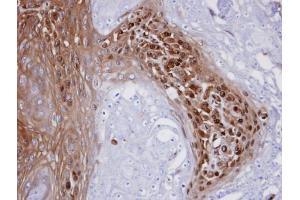 IHC-P Image Immunohistochemical analysis of paraffin-embedded CA922 xenograft, using WBSCR22 , antibody at 1:100 dilution.