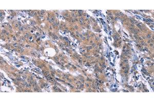 Immunohistochemistry of paraffin-embedded Human gasrtic cancer tissue using ESPL1 Polyclonal Antibody at dilution 1:40