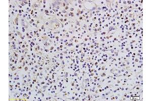 Formalin-fixed and paraffin embedded human colon cancer labeled with Anti-SATB1 Polyclonal Antibody, Unconjugated (ABIN732008) followed by conjugation to the secondary antibody and DAB staining (SATB1 anticorps  (AA 671-764))