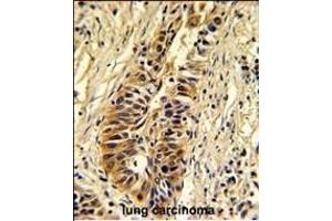 Formalin-fixed and paraffin-embedded human lung carcinoma reacted with TALDO1 Antibody (Center), which was peroxidase-conjugated to the secondary antibody, followed by DAB staining.