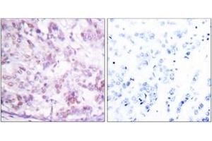 Immunohistochemistry analysis of paraffin-embedded human breast carcinoma tissue, using MYB (Ab-12) Antibody. (MYB anticorps  (AA 1-50))