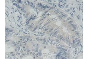 Detection of ROR2 in Human Colorectal cancer Tissue using Polyclonal Antibody to Receptor Tyrosine Kinase Like Orphan Receptor 2 (ROR2) (ROR2 anticorps  (AA 683-934))