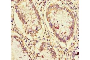 Immunohistochemistry of paraffin-embedded human colon cancer using ABIN7161865 at dilution of 1:100 (NCOA6 anticorps  (AA 285-504))