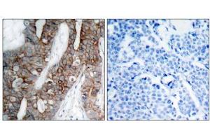 Immunohistochemical analysis of paraffin-embedded human breast carcinoma tissue using Integrin β3 (Ab-773) antibody (E021082). (Integrin beta 3 anticorps)