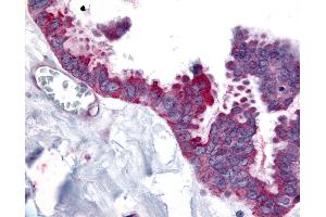 Anti-WNT2B antibody IHC of human Ovary, Carcinoma. (WNT2B anticorps  (N-Term))