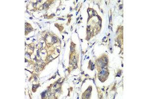 Immunohistochemistry of paraffin-embedded human liver cancer using NFS1 antibody at dilution of 1:100 (x40 lens). (NFS1 anticorps)