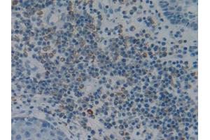 IHC-P analysis of Human Skin cancer Tissue, with DAB staining. (Fibrillin 1 anticorps  (AA 723-902))
