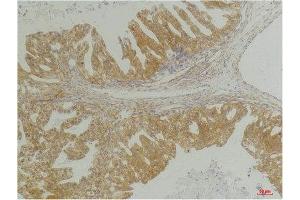 Immunohistochemistry (IHC) analysis of paraffin-embedded Human Breast Carcinoma using CXCR4 Rabbit Polyclonal Antibody diluted at 1:200. (CXCR4 anticorps)
