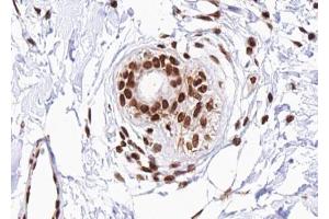 ABIN6267488 at 1/100 staining human Breast carcinoma tissue sections by IHC-P. (DDIT3 anticorps  (pSer30))