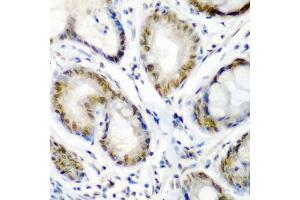 Immunohistochemistry of paraffin-embedded human colon carcinoma using SS18 antibody (ABIN5975075) at dilution of 1/200 (40x lens). (SS18 anticorps)
