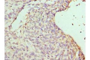 Immunohistochemistry of paraffin-embedded human endometrial cancer using ABIN7155457 at dilution of 1:100 (RBBP7 anticorps  (AA 1-230))