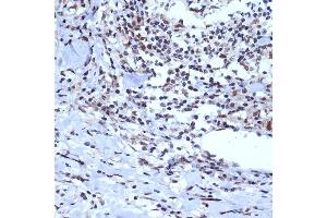 Immunohistochemistry of paraffin-embedded human esophageal cancer using A Rabbit mAb (ABIN7265387) at dilution of 1:100 (40x lens). (BAF53A anticorps)