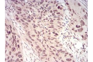 Immunohistochemical analysis of paraffin-embedded cervical cancer tissues using WTAP mouse mAb with DAB staining.