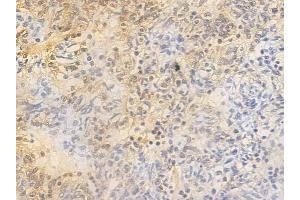 ABIN6255512 and ABIN6267316 at 1/100 staining human thymoma by IHC-P.