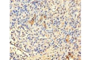 Immunohistochemistry of paraffin-embedded human bladder cancer using ABIN7172423 at dilution of 1:100 (TCEANC2 anticorps  (N-Term))
