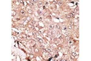 IHC analysis of FFPE human hepatocarcinoma stained with the LSD1 antibody