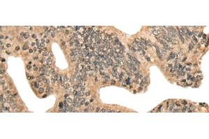 Immunohistochemistry of paraffin-embedded Human colorectal cancer tissue using CCNB1IP1 Polyclonal Antibody at dilution of 1:30(x200)