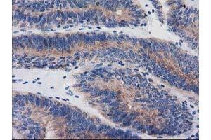 Immunohistochemical staining of paraffin-embedded Adenocarcinoma of Human endometrium tissue using anti-BIN3 mouse monoclonal antibody. (BIN3 anticorps)