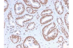 Formalin-fixed, paraffin-embedded human Prostate Carcinoma stained with ATRX Rabbit Recombinant Monoclonal Antibody (ATRX/2900R). (Recombinant ATRX anticorps)