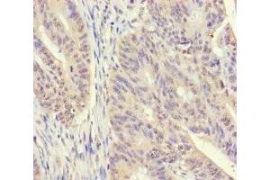 Immunohistochemistry of paraffin-embedded human colon cancer using ABIN7170541 at dilution of 1:100 (Spermidine Synthase anticorps  (AA 17-302))