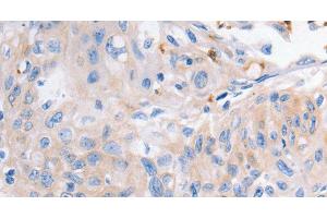 Immunohistochemistry of paraffin-embedded Human cervical cancer using KCNA1 Polyclonal Antibody at dilution of 1:30 (KCNA1 anticorps)