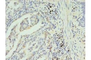 Immunohistochemistry of paraffin-embedded human lung cancer using ABIN7170235 at dilution of 1:100
