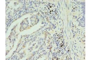 Immunohistochemistry of paraffin-embedded human lung cancer using ABIN7170235 at dilution of 1:100 (SLC35F5 anticorps  (AA 122-242))