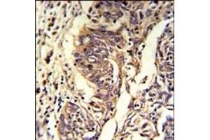 Formalin-fixed and paraffin-embedded human lung carcinoma reacted with KYNU Antibody (C-term), which was peroxidase-conjugated to the secondary antibody, followed by DAB staining. (KYNU anticorps  (C-Term))